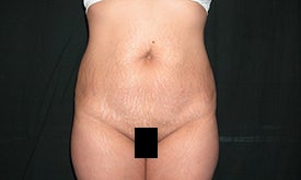 32 year old woman treated for abdominal wall laxity before 1187748
