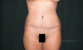 32 year old woman treated for abdominal wall laxity after 1187748