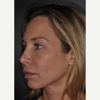 35-44 year old woman treated with Revision Rhinoplasty 2 weeks post-op before 3452237