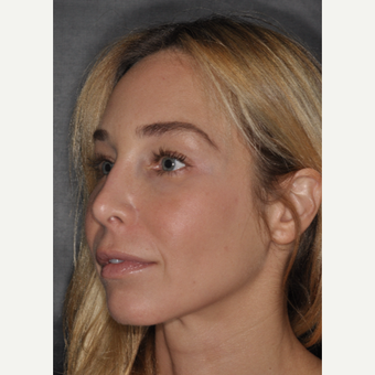 35-44 year old woman treated with Revision Rhinoplasty 2 weeks post-op after 3452237