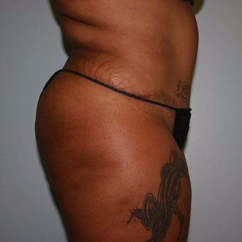 Brazilian Butt Lift before 3667419