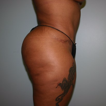 Brazilian Butt Lift after 3667419