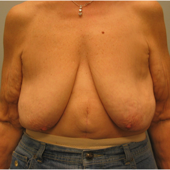 Body Lift before 3680267