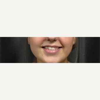 18-24 year old woman treated with Lip Augmentation before 3458831