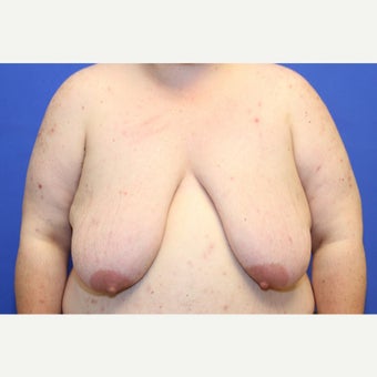 41 year old trans man treated with FTM Chest Masculinization Surgery before 2096517