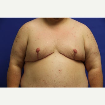 41 year old trans man treated with FTM Chest Masculinization Surgery after 2096517
