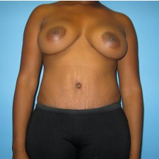 33 year old woman treated with Mommy Makeover after 3293495
