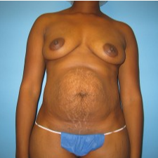33 year old woman treated with Mommy Makeover before 3293495