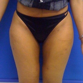 Laser Liposuction after 561206