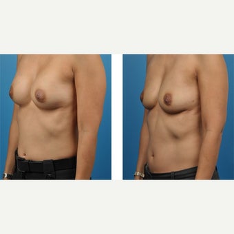 38 year old woman treated with Breast Implant Removal after 2524207