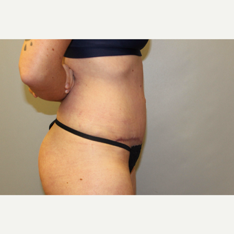 25-34 year old woman treated with Tummy Tuck after 3529255