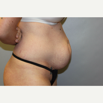 25-34 year old woman treated with Tummy Tuck before 3529255
