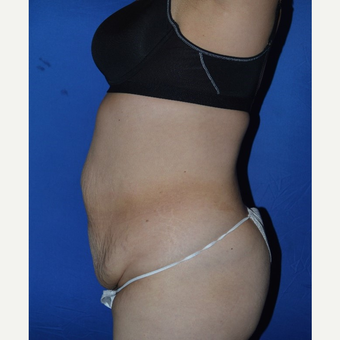 45-54 year old woman treated with No-Drain Tummy Tuck before 3655712