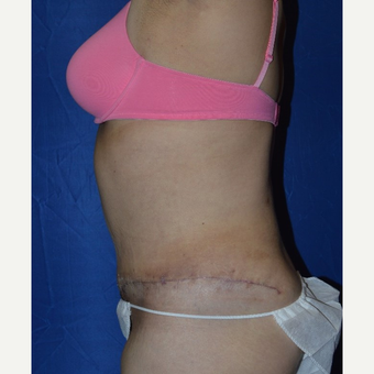 45-54 year old woman treated with No-Drain Tummy Tuck after 3655712
