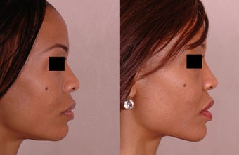 Rhinoplasty before 677280