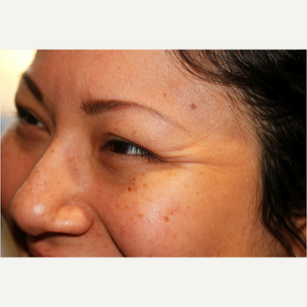 Getting rid of Crow's Feet with Botox before 2780500