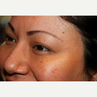 Getting rid of Crow's Feet with Botox after 2780500