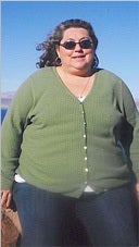Female Gastric Bypass Patient Lost 175 lb before 916234