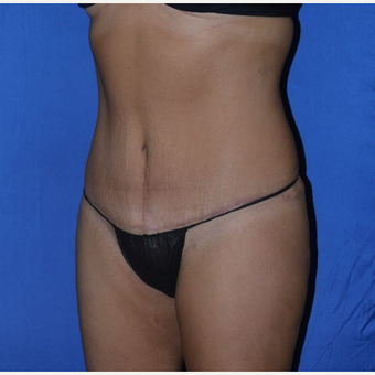 35-44 year old woman treated with No-Drain Tummy Tuck after 3655679