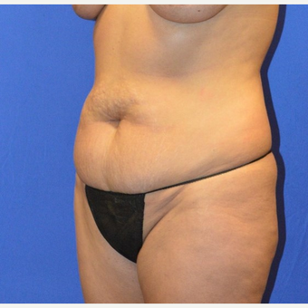 35-44 year old woman treated with No-Drain Tummy Tuck before 3655679