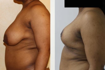 31 year old patient with large saggy breast before 1397099