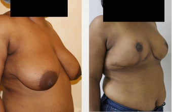 31 year old patient with large saggy breast 1397099
