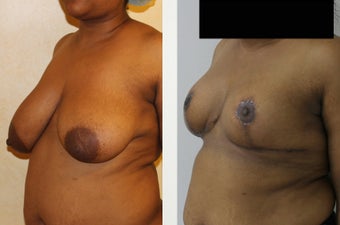 31 year old patient with large saggy breast after 1397099