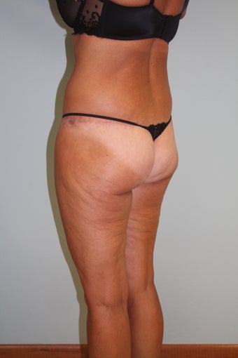 55year old lady with flat buttocks saddle bags and lax thighs 1523109