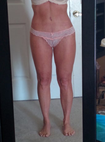 55year old lady with flat buttocks saddle bags and lax thighs after 1523109