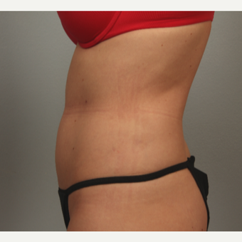 35-44 year old woman treated with radiofrequency-assisted liposuction of the abdomen after 3281546