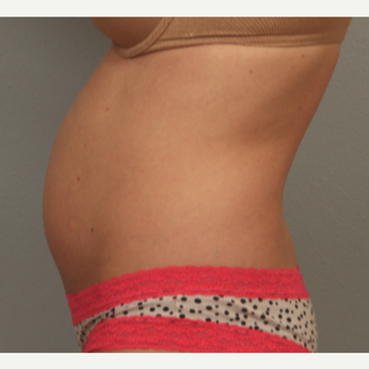 35-44 year old woman treated with radiofrequency-assisted liposuction of the abdomen before 3281546