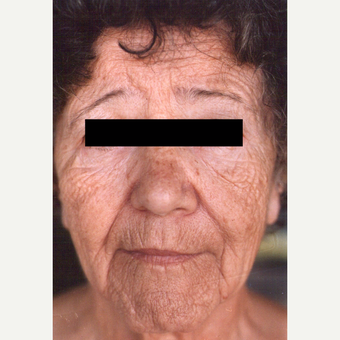 55-64 year old woman treated with Chemical Peel before 3543226