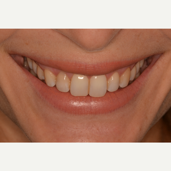 35-44 year old woman treated with Gum Lift after 3629120