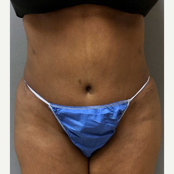 Woman treated with Tummy Tuck after 1808861
