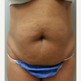 Woman treated with Tummy Tuck before 1808861