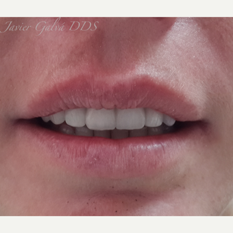 Front teeth accident treated with Smile Makeover after 3119670