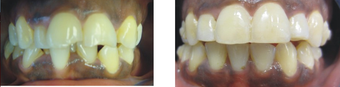 Teeth makeover with Invisalign before 654065