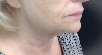65-74 year old woman treated with Pelleve after 1599150