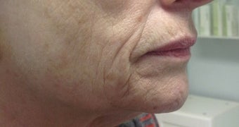 65-74 year old woman treated with Pelleve before 1599150