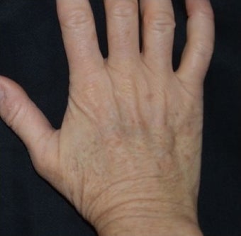 54 Year Old Female Treated for Sun Spots on an Aging Hand 1367269