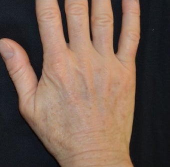 54 Year Old Female Treated for Sun Spots on an Aging Hand 1367269