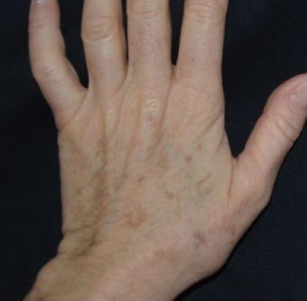 54 Year Old Female Treated for Sun Spots on an Aging Hand before 1367269