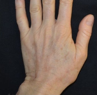 54 Year Old Female Treated for Sun Spots on an Aging Hand after 1367269
