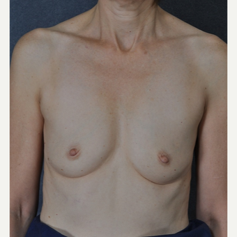 Breast Augmentation before 3816048