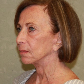 75 and up year old woman treated with Fractional Laser and face and neck lift 1754652