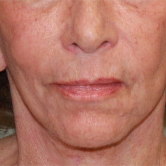 75 and up year old woman treated with Fractional Laser and face and neck lift after 1754652