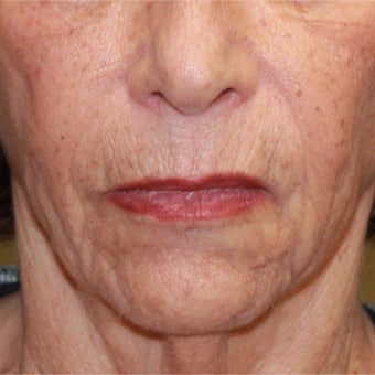 75 and up year old woman treated with Fractional Laser and face and neck lift before 1754652