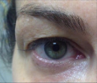45-54 year old woman treated with Pelleve before 3440750