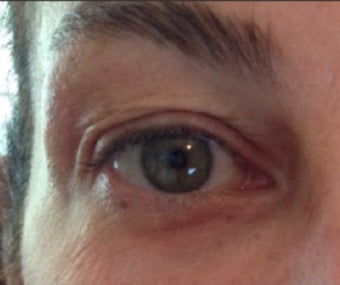 45-54 year old woman treated with Pelleve after 3440750