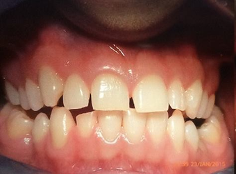 Braces before 3031447